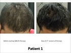 QR 678 | Hair Growth Treatment | Best Hair Loss Solution in Mumbai, India- Dr. Rinky Kapoor.