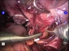 robot assisted cystoprostatectomy